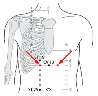 承滿穴→治胃痛、胃痙攣