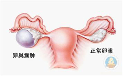 卵巢囊腫，抱腿壓涌泉穴，給你愛心呵護(hù)