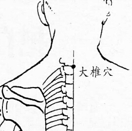 大椎-中醫(yī)拔罐常用穴位