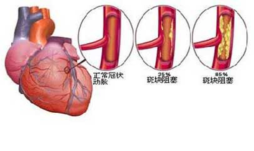 冠心病